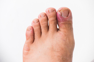 Severe Ingrown Toenails on foot of a person